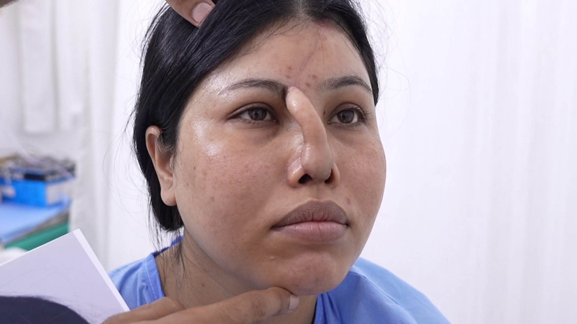 Forehead Flap Reconstruction Surgery